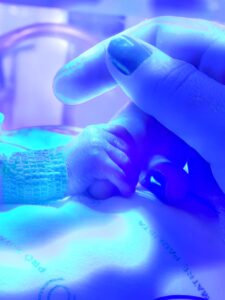 síndrome de edwards